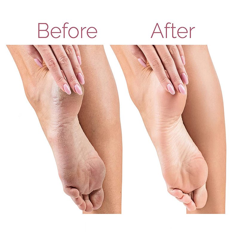 Electric Pedicure Foot File Callus Remover Rechargeable Foot Care Device