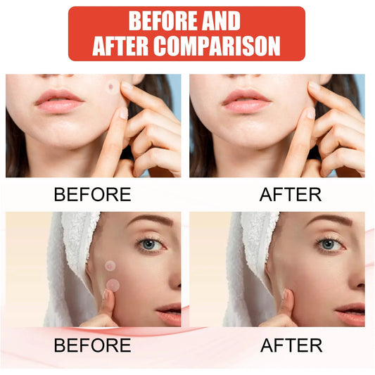 Hydrocolloid Acne Cleaning Patch for Spot Treatment Blemish Care 144 Patches
