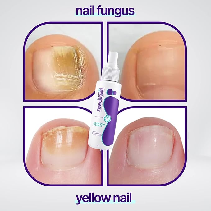 Jaysuing Nail Fungus Spray Antifungal Nail Care Treatment Solution 100ml