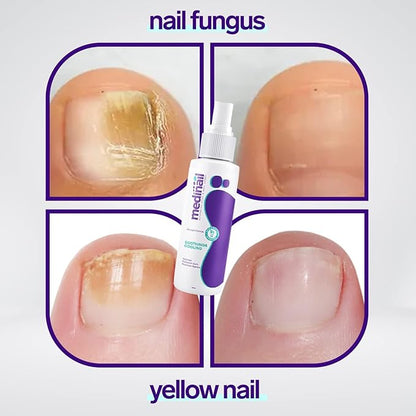 Jaysuing Nail Fungus Spray Antifungal Nail Care Treatment Solution 100ml