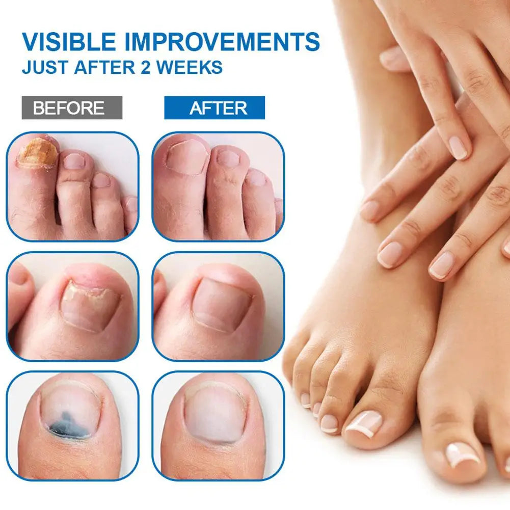 Sumifun Nail Fungus Treatment Liquid Antifungal Nail Repair Solution 20ml