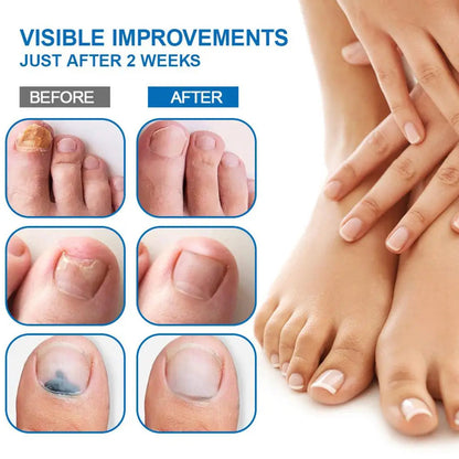 Sumifun Nail Fungus Treatment Liquid Antifungal Nail Repair Solution 20ml